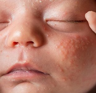 O que é acne neonatal?