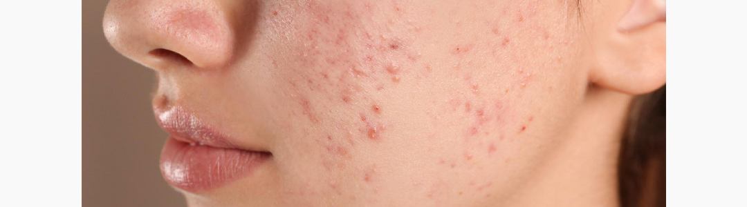 O que causa a acne?