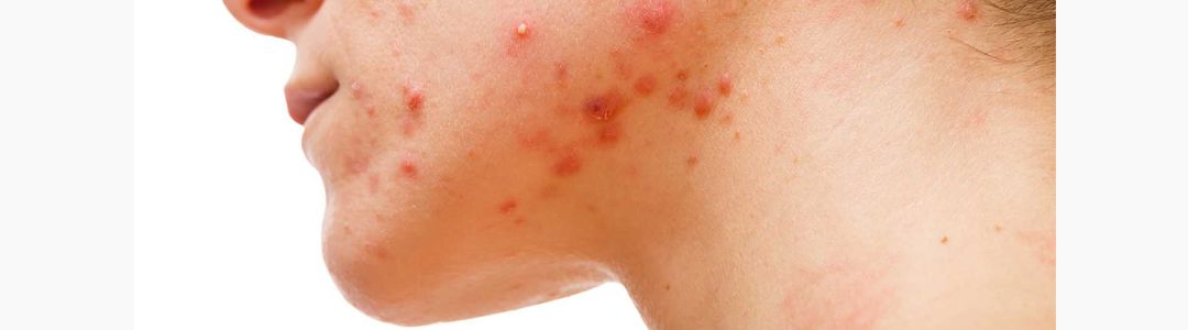 O que causa muitas espinhas no rosto - acne hormonal