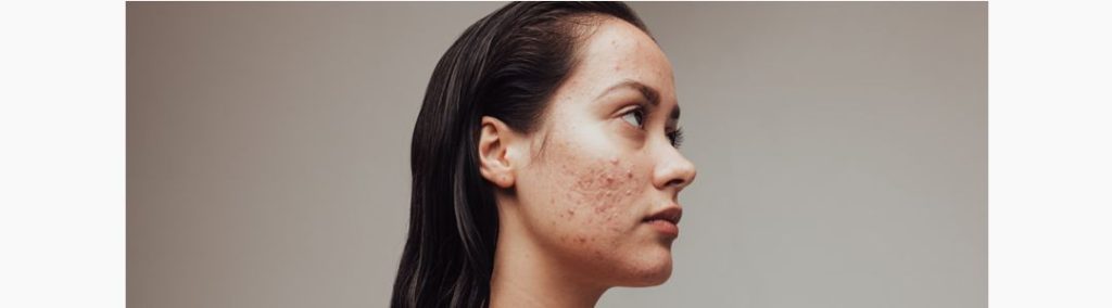 Rosto com espinha: o que causa surtos de acne e como tratar