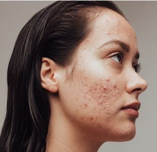 Rosto com espinha: o que causa surtos de acne e como tratar