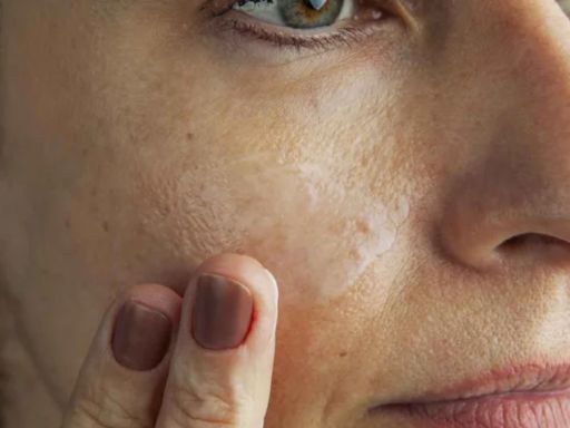 Cuidados com a pele no inverno: clareadores e antirugas