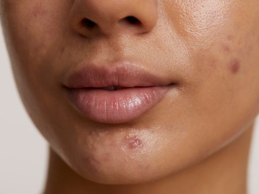 Manchas de espinha: causas, tratamentos e prevenção