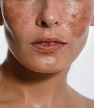 Melasma no rosto: guia definitivo de como cuidar das manchas!