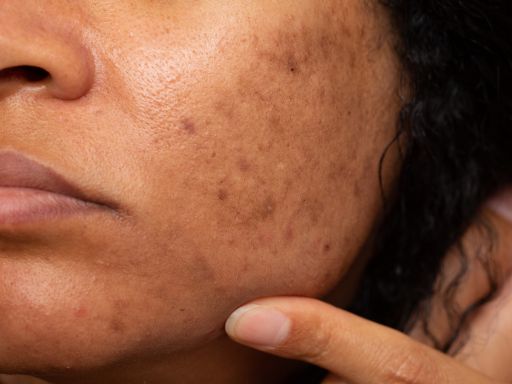 Principais tipos de melasma