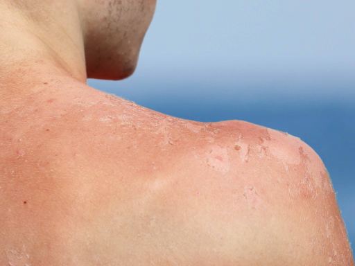 Ações imediatas - o que fazer ao perceber que exagerou no sol