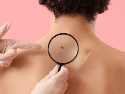 Melanoma, o que é e como identificar - Guia com dermatologista