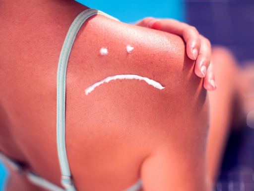 O que passar em queimadura solar - dicas de dermatologistas
