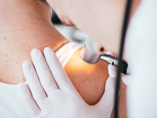 Quais são os principais tipos de melanoma