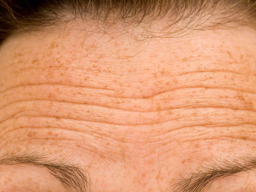 Quais são os principais tipos de rugas