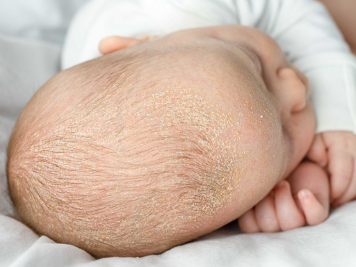 Tipos mais comuns de dermatite - dermatite seborreica